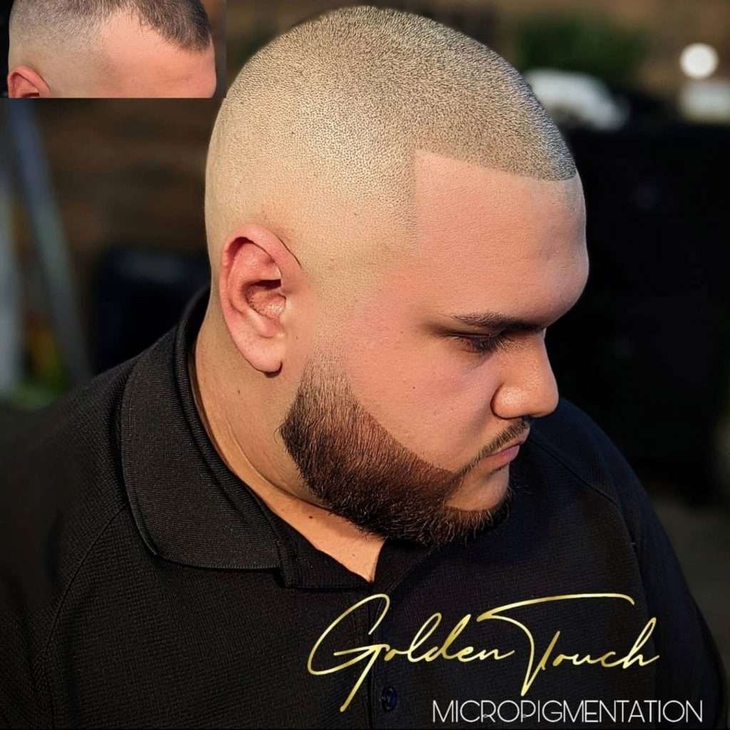 before and after male smp treatment