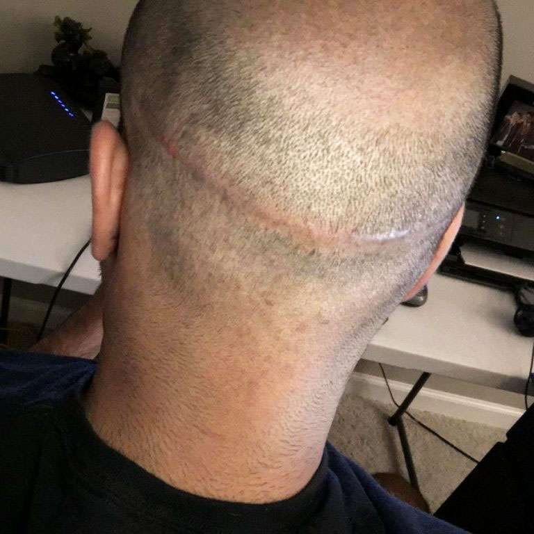 scarring from transplants